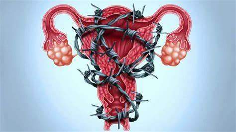 Diagnóstico de Endometriose