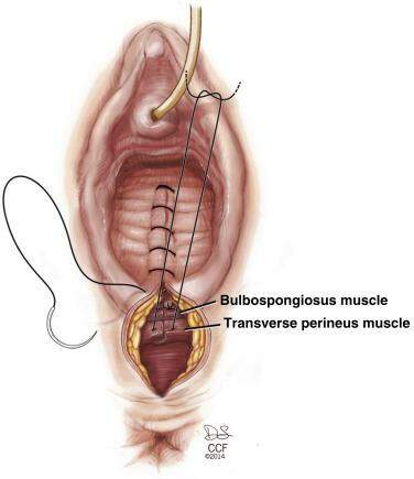 Cirurgia Vaginal