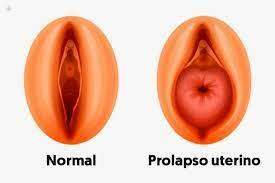 Cirurgia Vaginal