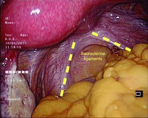 Tratamento Cirúrgico para Endometriose