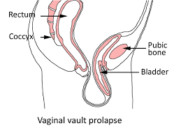 Cirurgia Vaginal