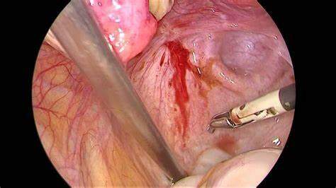 Tratamento Cirúrgico para Endometriose