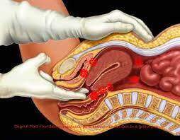 Tratamento Cirúrgico para Endometriose