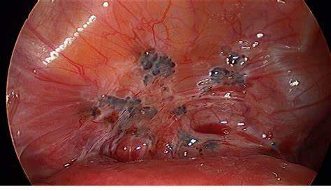 Tratamento Cirúrgico para Endometriose