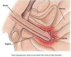 Diagnóstico de Endometriose