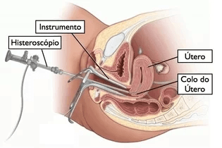 O que é Histeroscopia