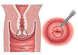 Cirurgia Vaginal