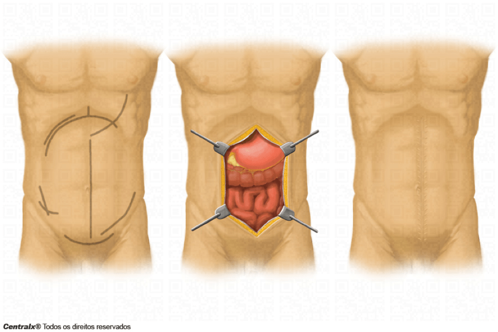 Laparotomia