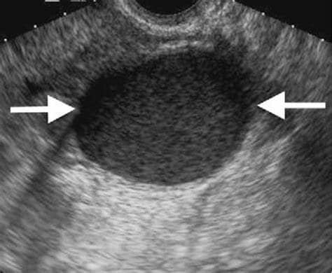 Tratamento Cirúrgico para Endometriose