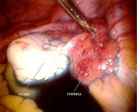 Tratamento Cirúrgico para Endometriose