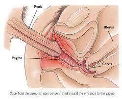 Diagnóstico de Endometriose