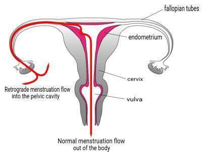 O que é Endometriose