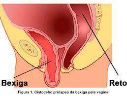 Cirurgia Vaginal