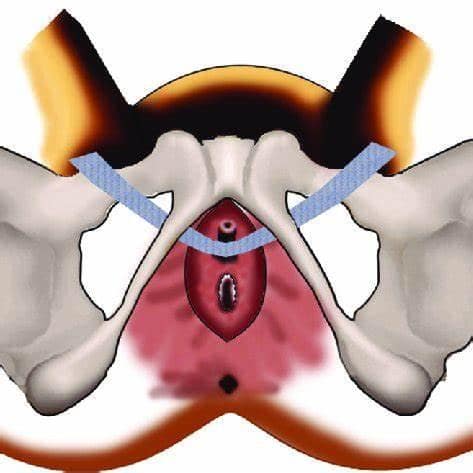 Cirurgia Vaginal