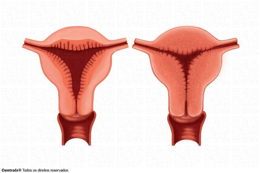 A esquerda útero com endométrio e espessado e a direita endométrio normal.