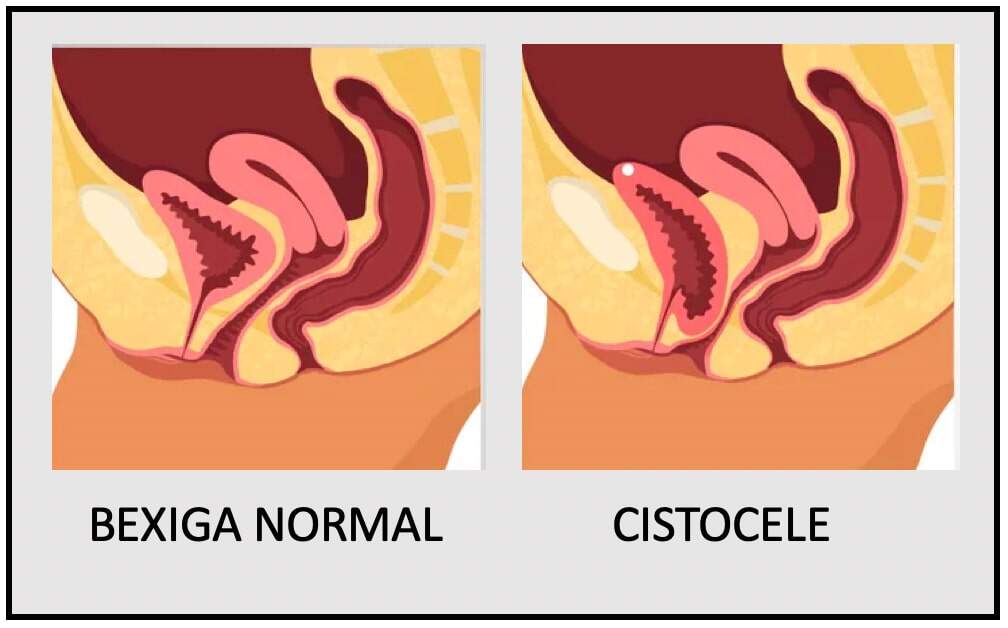 Prolapso genital