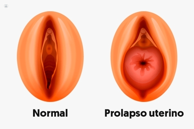 Prolapso genital