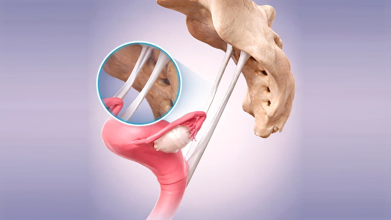 Exemplo 3 D de endometriose nos ligamentos uterossacros