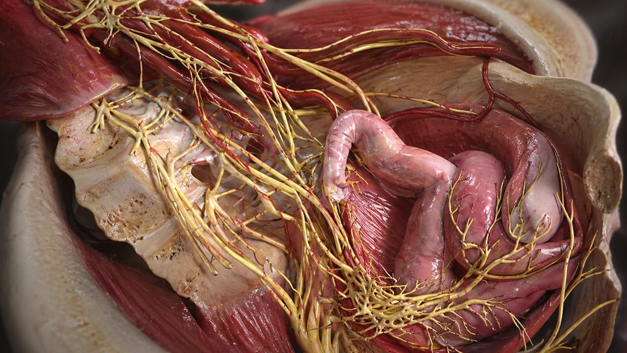 Exemplo de Endometriose no nervo hipogástrico