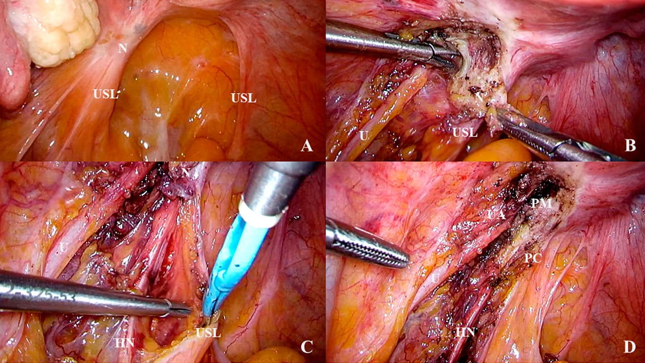 Exemplo de focos de endometriose nos ligamentos uterossacros