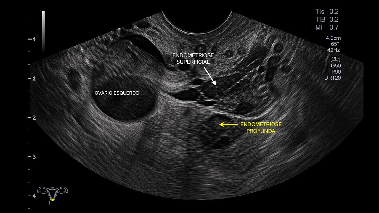 Imagem de ultrassom ilustrando endometriose profunda ou superficial na região pélvica feminina, evidenciando lesões em diferentes camadas dos tecidos.