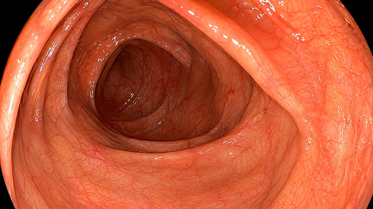 Colonoscopia para endometriose mostrando a visualização interna do intestino durante o exame.