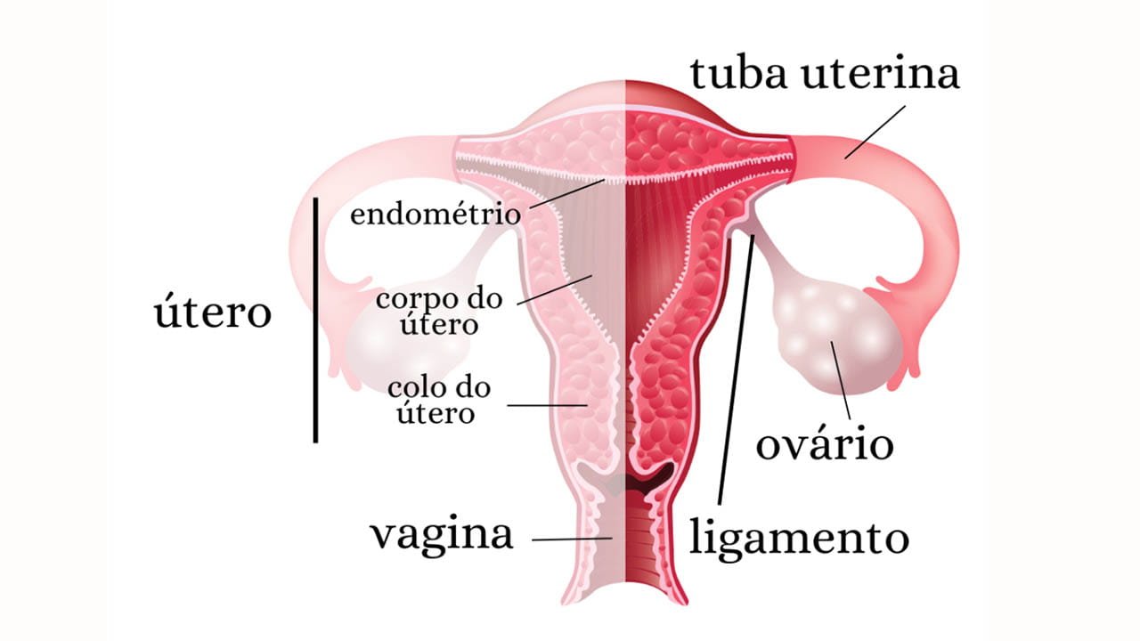 Ilustração Placa retrocervical de endometriose