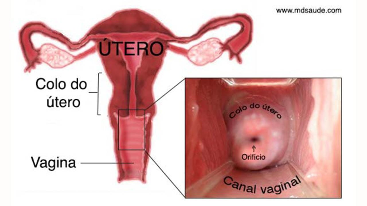 Ilustração de útero com Placa retrocervical de endometriose