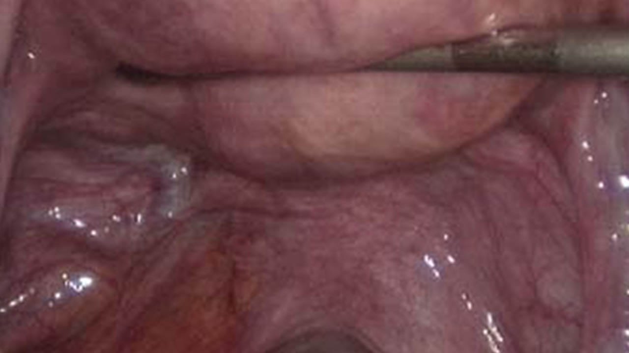 Imagem 1 sobre endometriose em fundo de saco vaginal