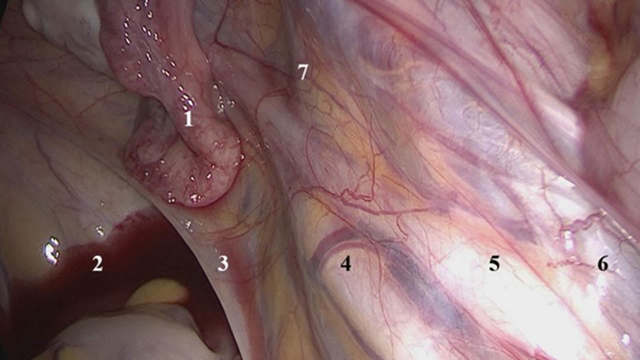 Imagem 2 sobre endometriose em fundo de saco vaginal