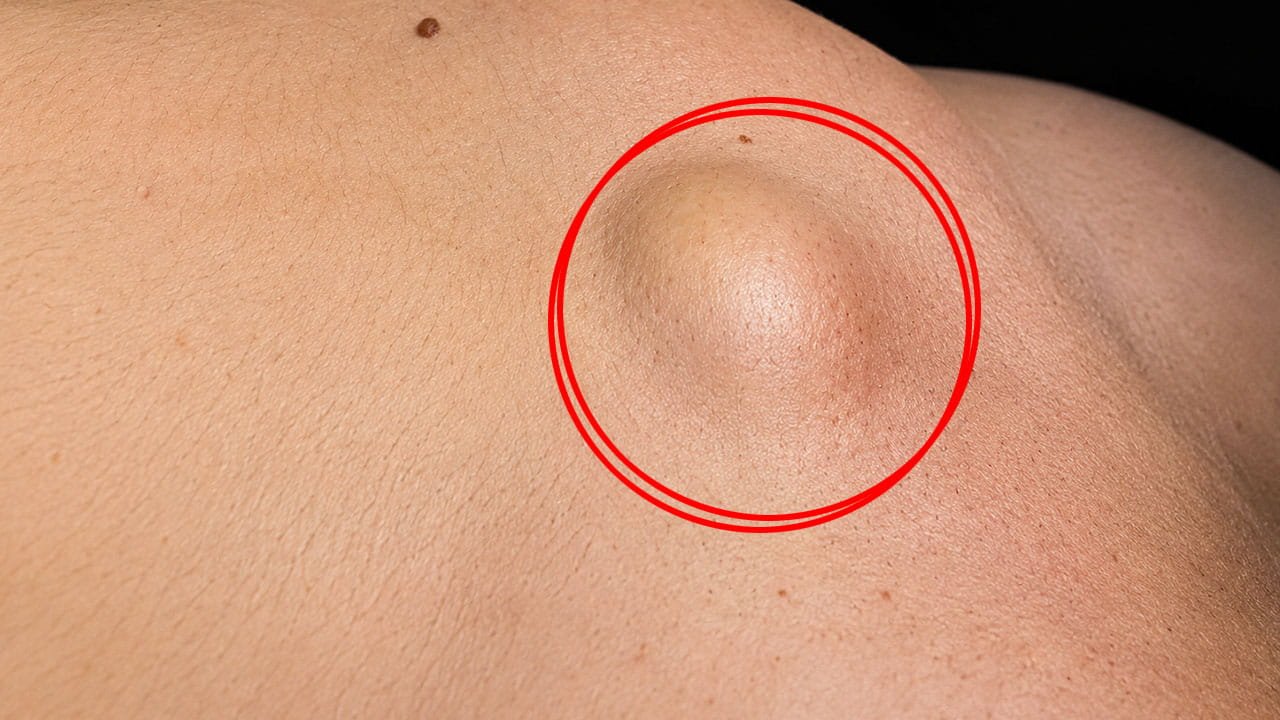 Nódulo de Endometriose