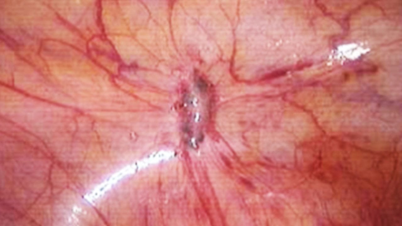 O que é um nódulo de endometriose